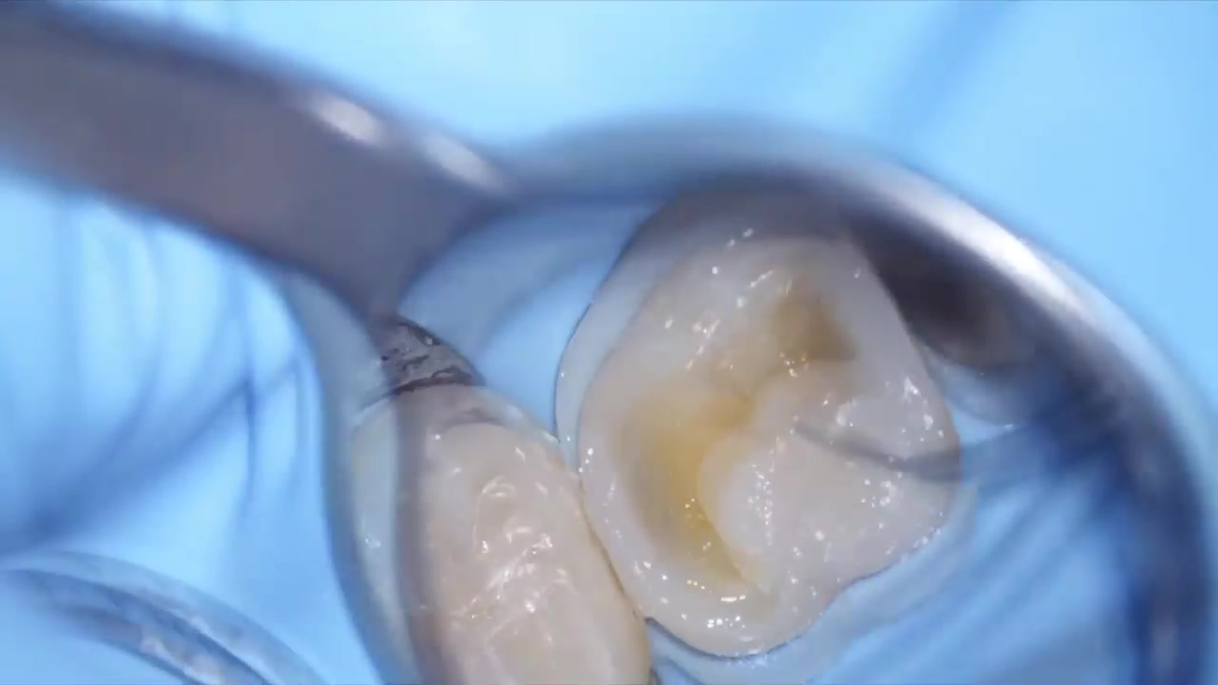 Реставрация