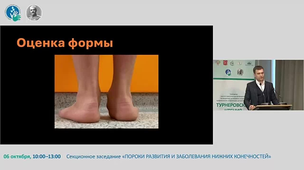 плоскостопие