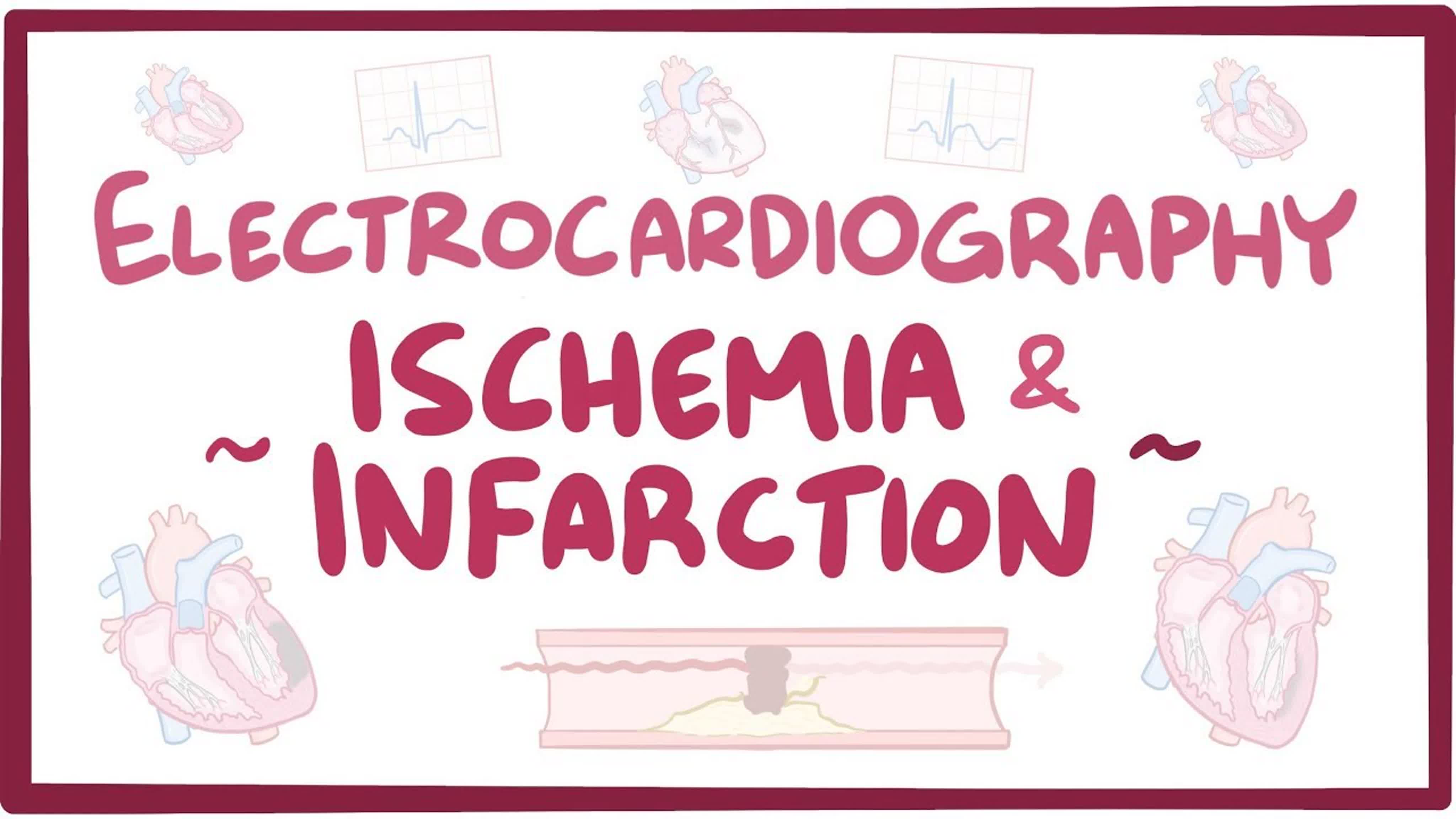 Cardiac arrhythmia's