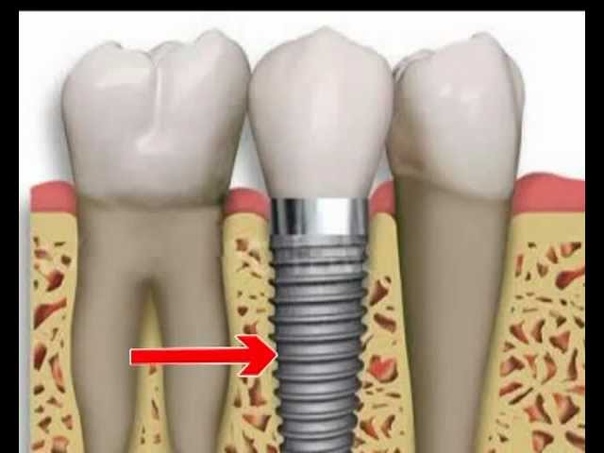 ЗДОРОВЬЕ. ЗУБНЫЕ ИМПЛАНТЫ.